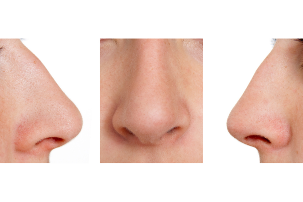 いちご鼻 治し方