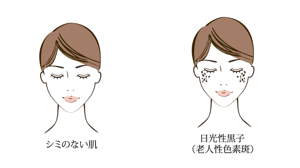 シミ 原因