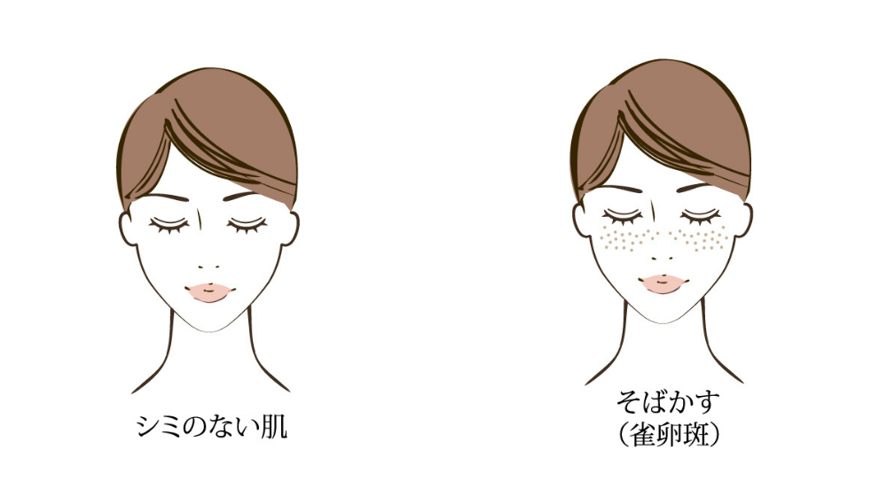 シミ 原因