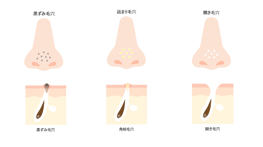 角栓除去 毛穴