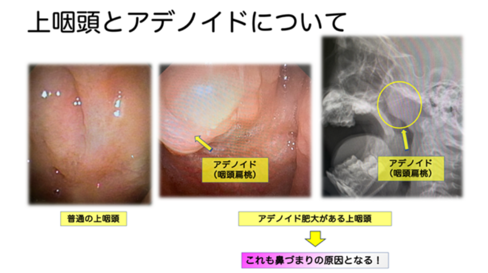 鼻詰まりの原因は？日常でできる解消方法や長引く場合の対処法を紹介