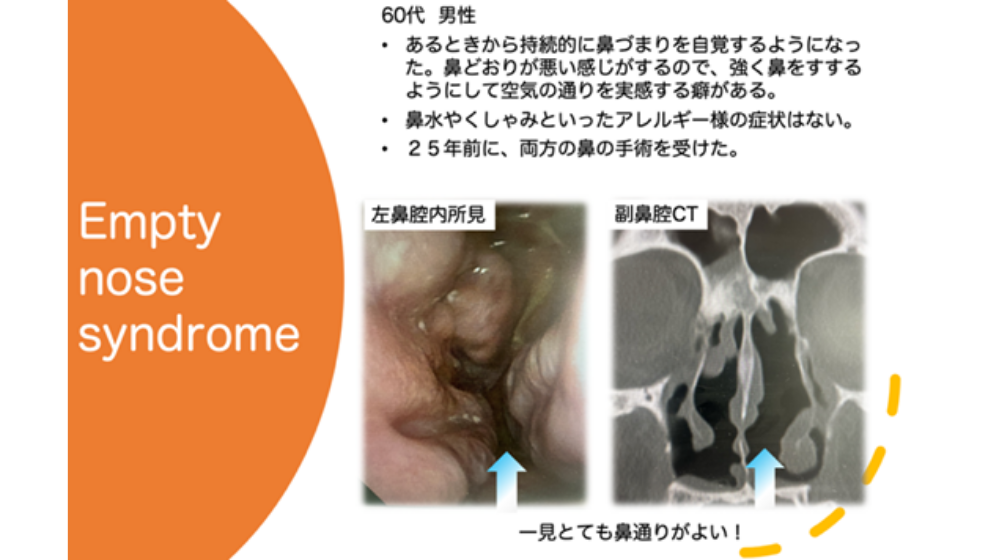 鼻詰まりの原因は？日常でできる解消方法や長引く場合の対処法を紹介
