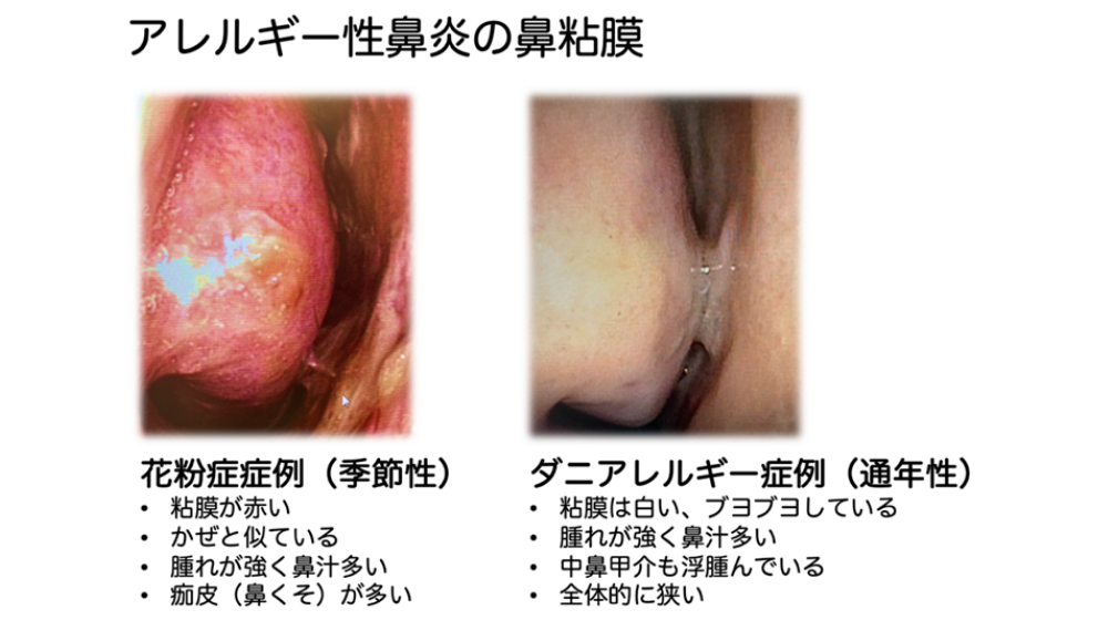 鼻詰まりの原因は？日常でできる解消方法や長引く場合の対処法を紹介