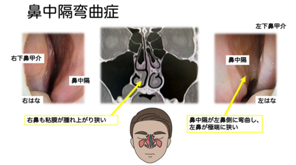 鼻詰まりの原因は？日常でできる解消方法や長引く場合の対処法を紹介