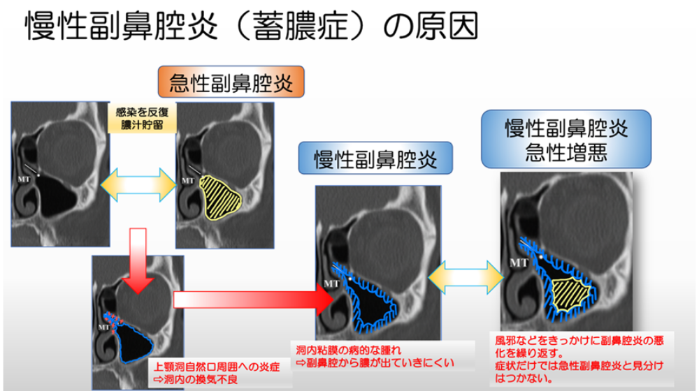 鼻詰まりの原因は？日常でできる解消方法や長引く場合の対処法を紹介