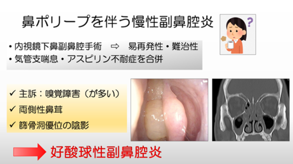鼻詰まりの原因は？日常でできる解消方法や長引く場合の対処法を紹介