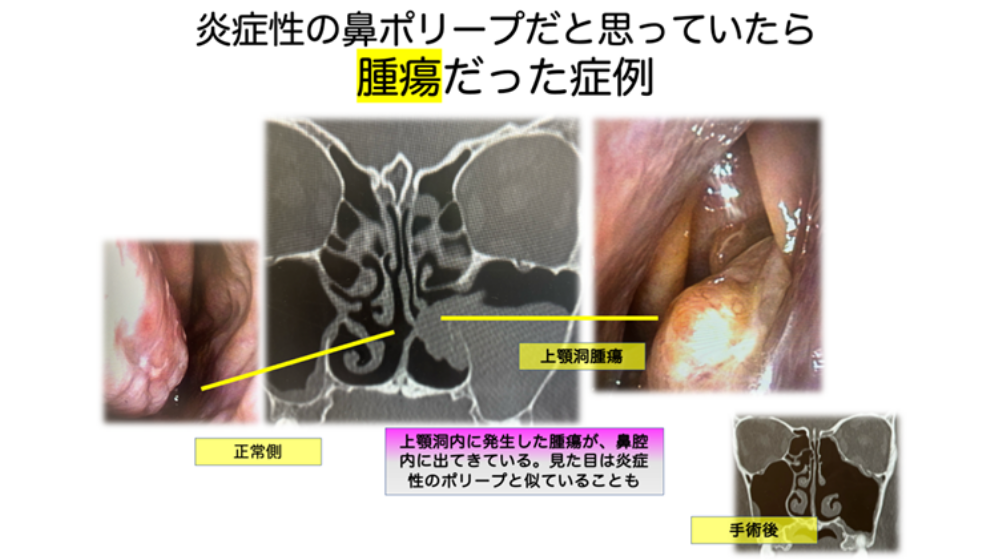 鼻詰まりの原因は？日常でできる解消方法や長引く場合の対処法を紹介