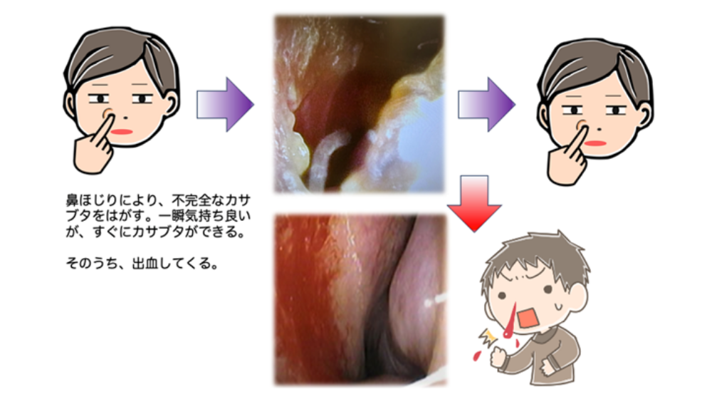 鼻詰まりの原因は？日常でできる解消方法や長引く場合の対処法を紹介