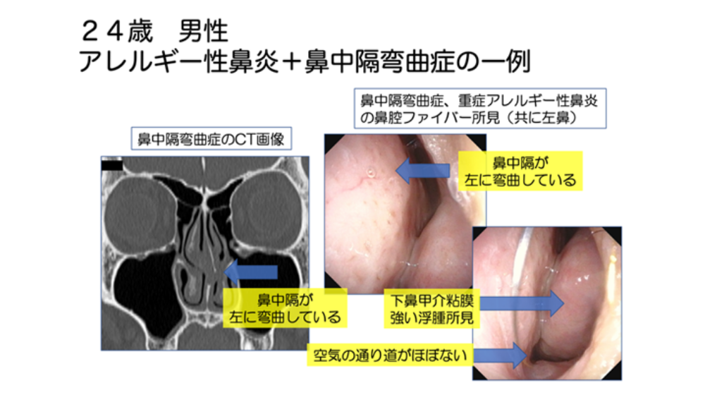 鼻詰まりの原因は？日常でできる解消方法や長引く場合の対処法を紹介