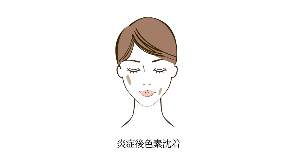 シミができやすい人の特徴