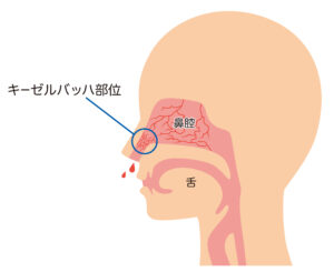 鼻血の説明