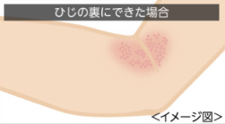 あせも