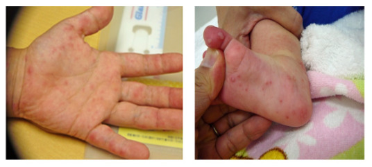 手足口病の症状や潜伏期間 子供だけでなく大人の初期症状やうつる確率について解説