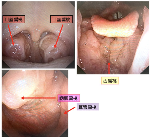 急性扁桃炎