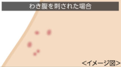 ダニに刺された場合の症状