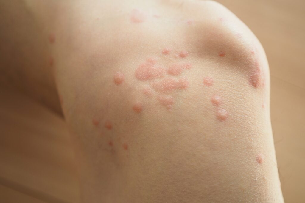 アレルギー性蕁麻疹の症状が出た時の適切な対応方法とは？