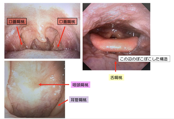 扁桃がんと扁桃炎に関するよくある質問