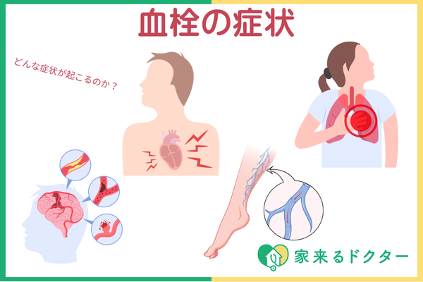 血栓とは?原因・症状・予防法・できやすい人の特徴を紹介 | 家来るドクター