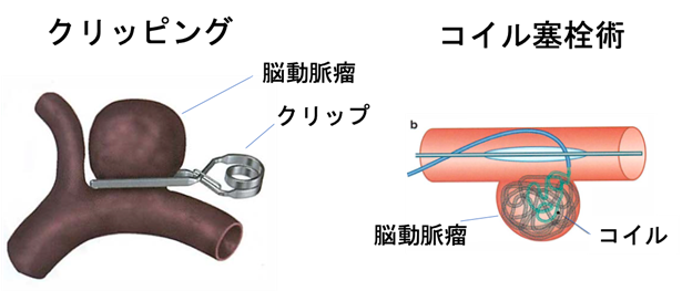 脳動脈瘤の手術の比較図 クリッピングとコイル塞栓術