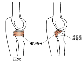 肘内障のしくみ 正常な肘と、輪状靭帯から橈骨頭がずれた状態の比較図